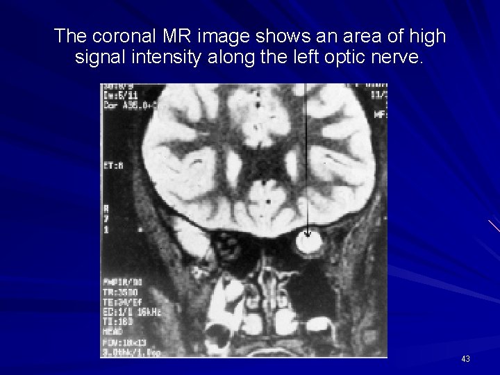 The coronal MR image shows an area of high signal intensity along the left