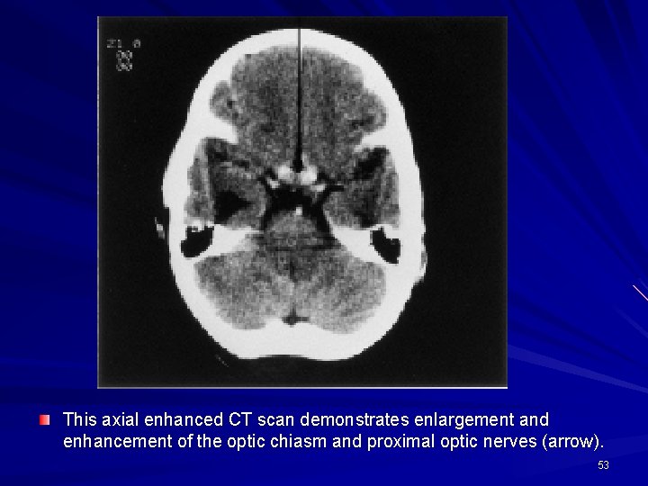 This axial enhanced CT scan demonstrates enlargement and enhancement of the optic chiasm and