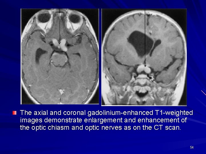 The axial and coronal gadolinium-enhanced T 1 -weighted images demonstrate enlargement and enhancement of