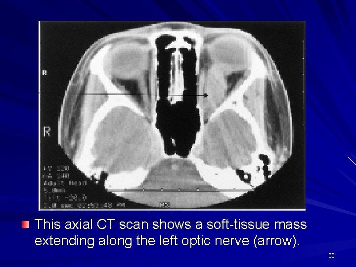 This axial CT scan shows a soft-tissue mass extending along the left optic nerve