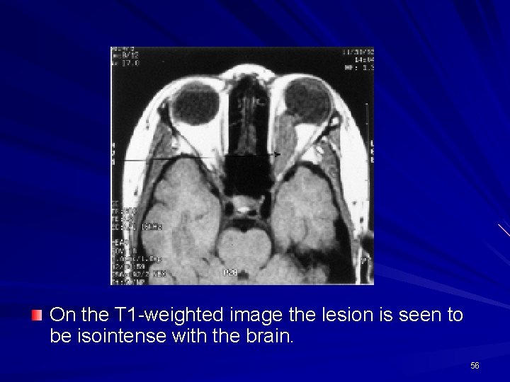 On the T 1 -weighted image the lesion is seen to be isointense with