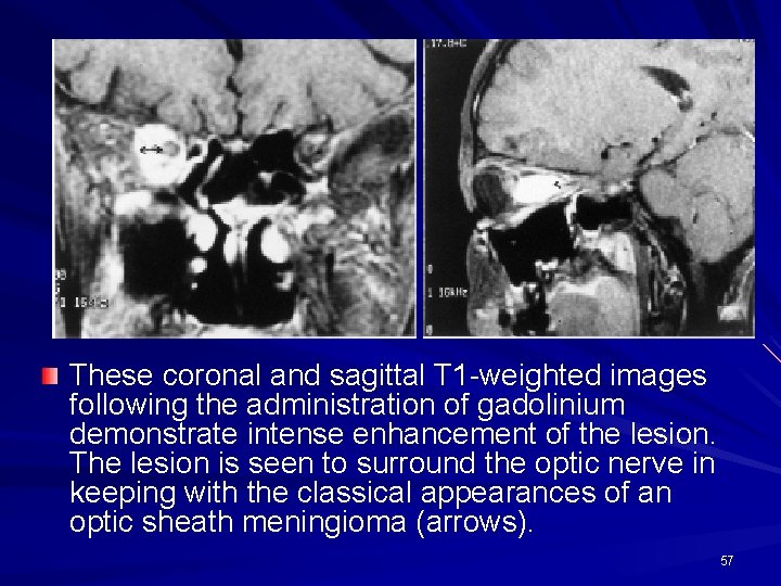 These coronal and sagittal T 1 -weighted images following the administration of gadolinium demonstrate