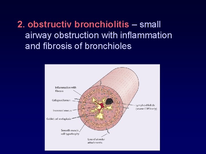 2. obstructiv bronchiolitis – small airway obstruction with inflammation and fibrosis of bronchioles 