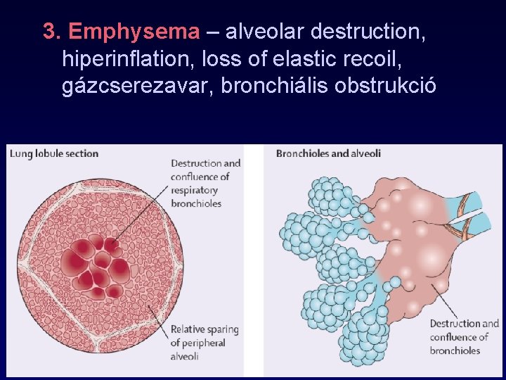 3. Emphysema – alveolar destruction, hiperinflation, loss of elastic recoil, gázcserezavar, bronchiális obstrukció 