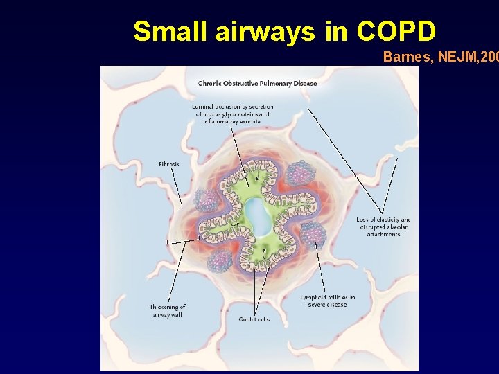 Small airways in COPD Barnes, NEJM, 200 