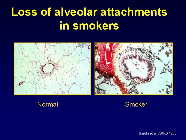 Loss of alveolar attachments in smokers Normal Smoker Saetta et al. ARRD 1985 