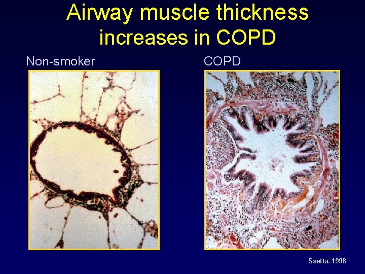 Airway muscle thickness increases in COPD Non-smoker COPD Saetta. 1998 