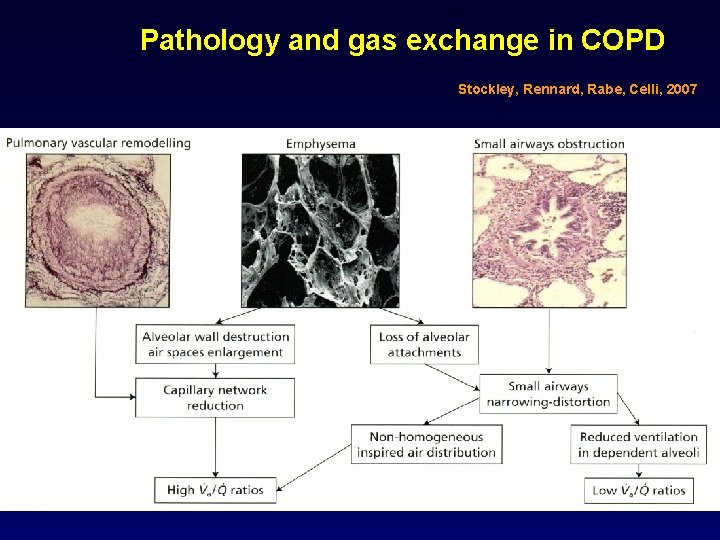 Pathology and gas exchange in COPD Stockley, Rennard, Rabe, Celli, 2007 