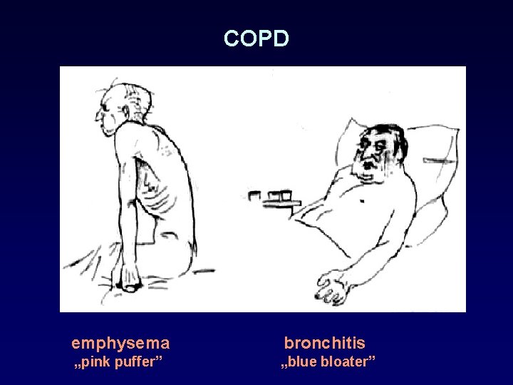COPD emphysema bronchitis „pink puffer” „blue bloater” 