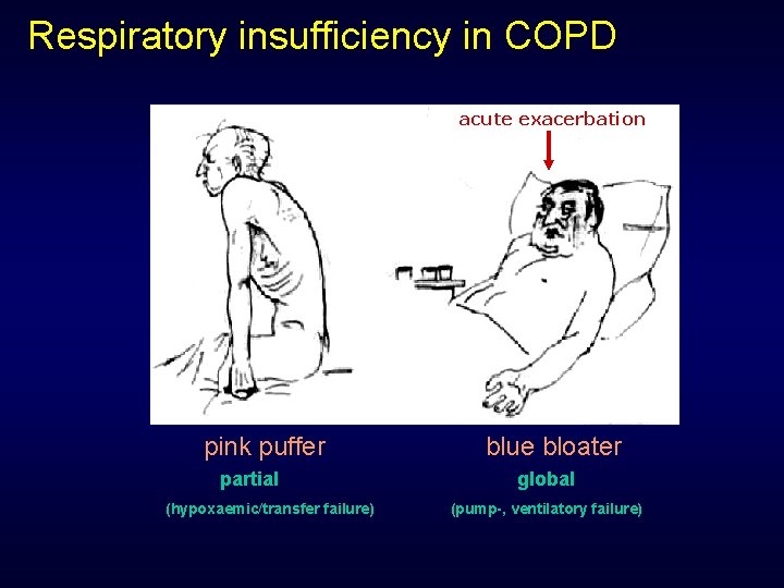Respiratory insufficiency in COPD acute exacerbation pink puffer partial (hypoxaemic/transfer failure) blue bloater global