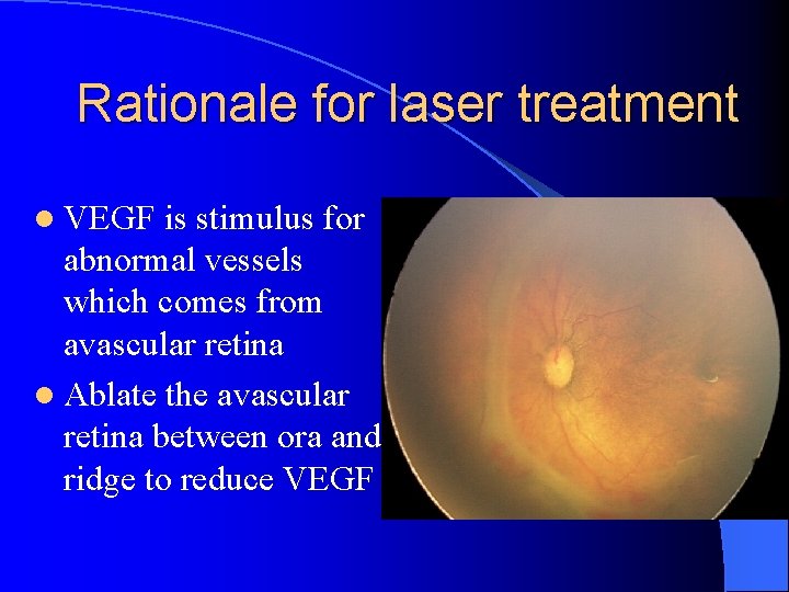 Rationale for laser treatment l VEGF is stimulus for abnormal vessels which comes from