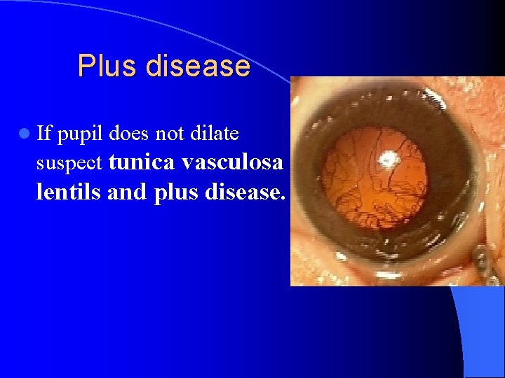 Plus disease l If pupil does not dilate suspect tunica vasculosa lentils and plus