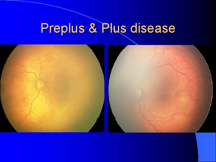 Preplus & Plus disease 