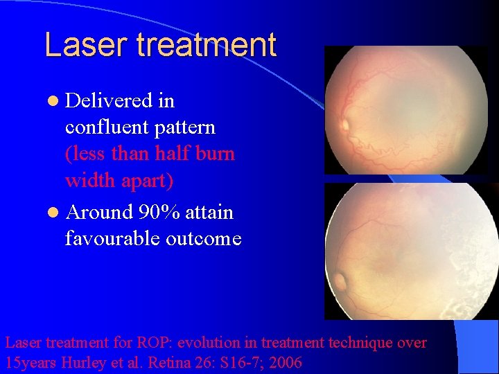 Laser treatment l Delivered in confluent pattern (less than half burn width apart) l