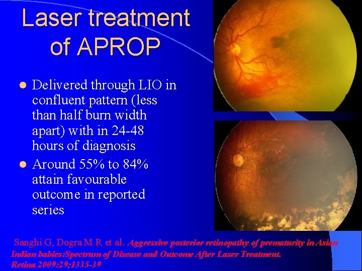 Laser treatment of APROP Delivered through LIO in confluent pattern (less than half burn