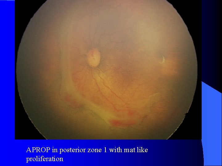 APROP in posterior zone 1 with mat like proliferation 