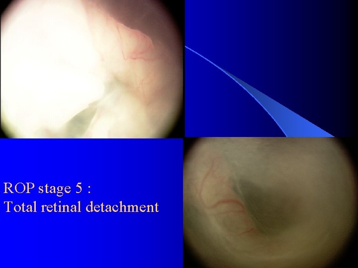 ROP stage 5 : Total retinal detachment 