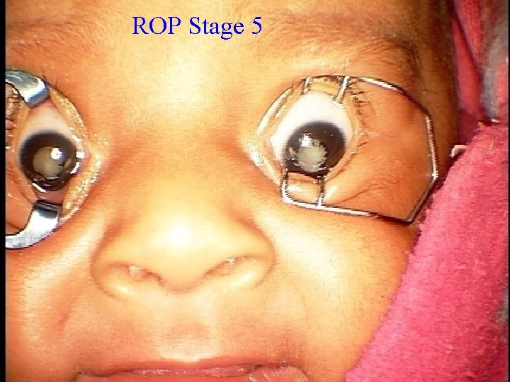 ROP Stage 5 
