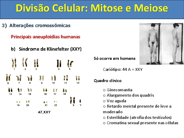 Divisão Celular: Mitose e Meiose 3) Alterações cromossômicas Principais aneuploidias humanas b) Síndrome de