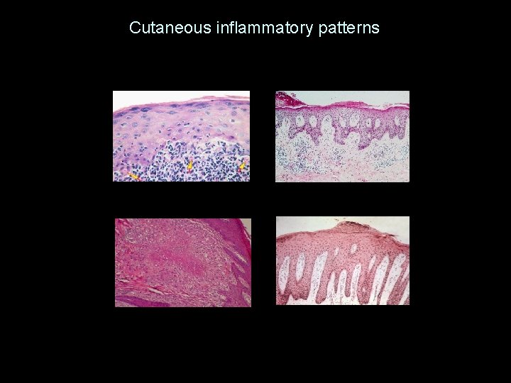 Cutaneous inflammatory patterns 