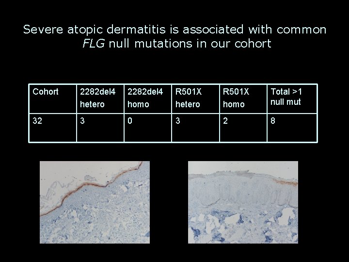 Severe atopic dermatitis is associated with common FLG null mutations in our cohort Cohort