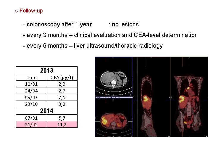 o Follow-up - colonoscopy after 1 year : no lesions - every 3 months