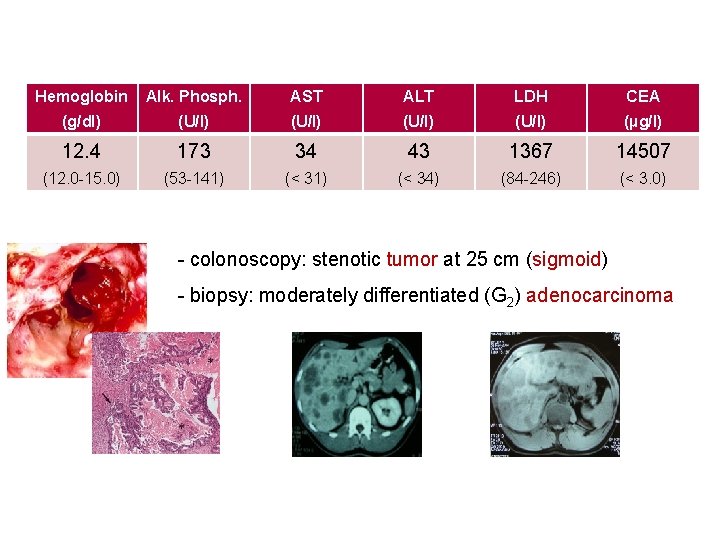 Hemoglobin Alk. Phosph. AST ALT LDH CEA (g/dl) (U/l) (µg/l) 12. 4 173 34