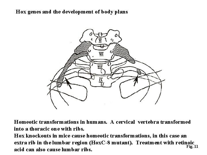 Hox genes and the development of body plans Homeotic transformations in humans. A cervical