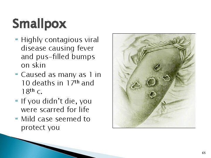 Smallpox Highly contagious viral disease causing fever and pus-filled bumps on skin Caused as