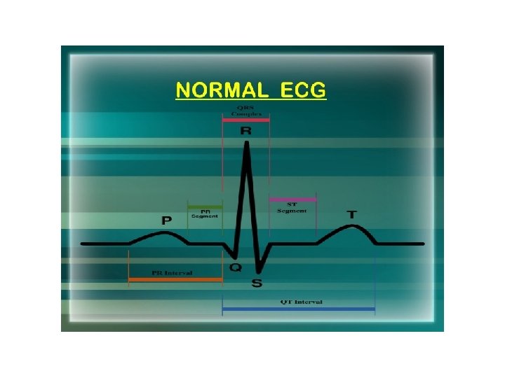 ECG 1 BIPOLAR LEADS I II III 2