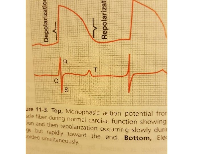 ECG 1 BIPOLAR LEADS I II III 2