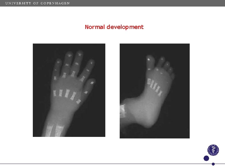 Normal development 