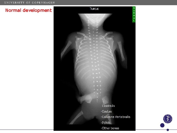 Normal development 