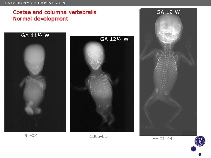 GA 19 W Costae and columna vertebralis Normal development GA 11½ W 94 -02