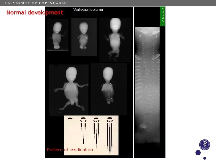 Normal development Pattern of ossification 