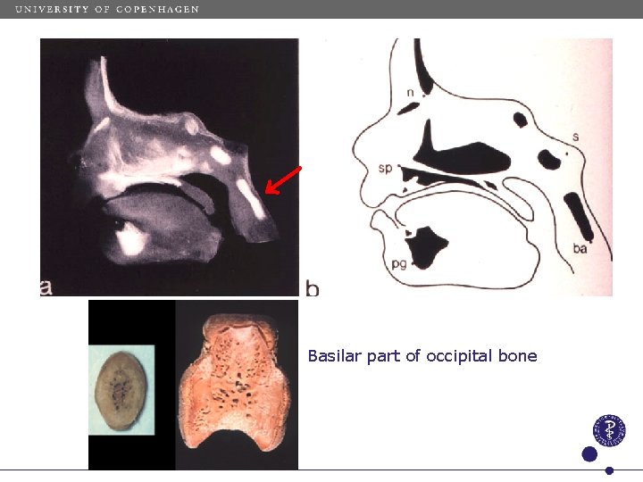 Basilar part of occipital bone 