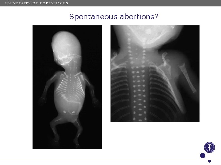Spontaneous abortions? 