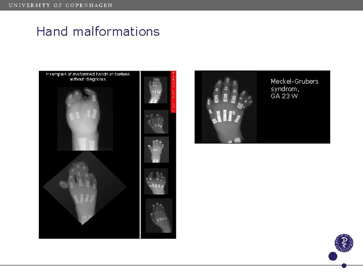 Hand malformations Meckel-Grubers syndrom, GA 23 W 