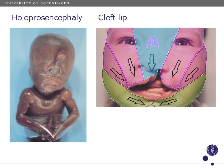 Holoprosencephaly Cleft lip 