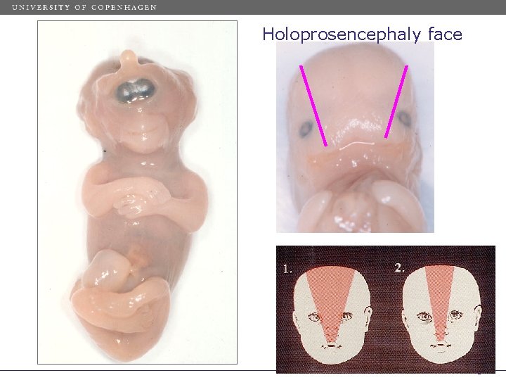 Holoprosencephaly face 