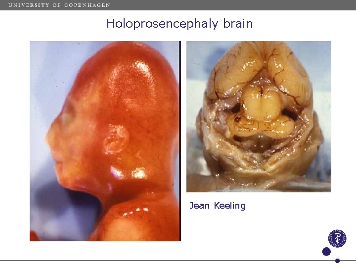 Holoprosencephaly brain Jean Keeling 