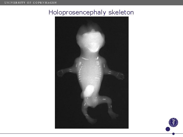 Holoprosencephali Holoprosencephaly skeleton 