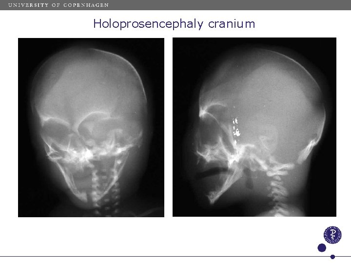 Holoprosencephaly cranium 