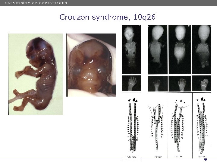 Crouzon syndrome, 10 q 26 