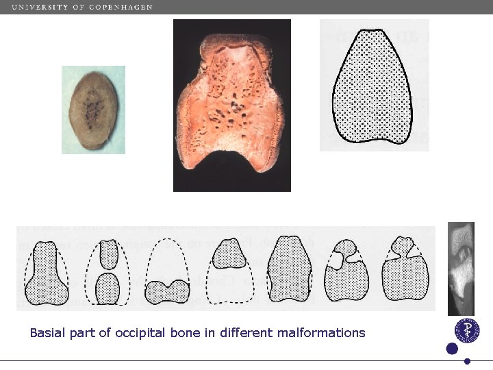 Basial part of occipital bone in different malformations 