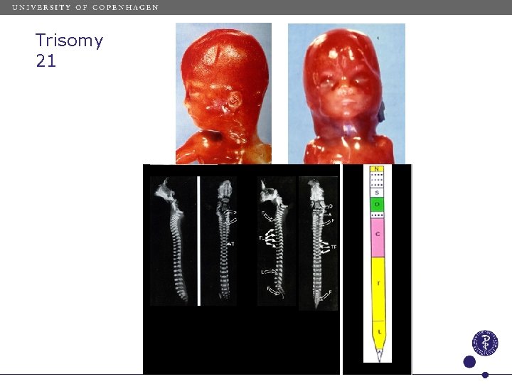 Trisomy 21 