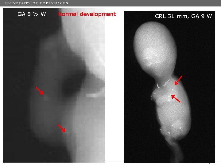 GA 8 ½ W Normal development CRL 31 mm, GA 9 W 