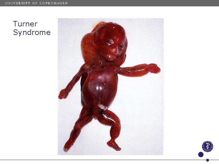 Turner syndrome Turner Syndrome 