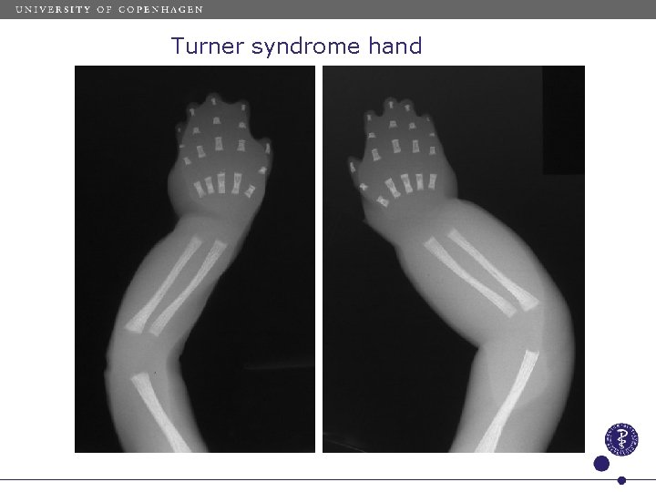 Turner syndrome hand 