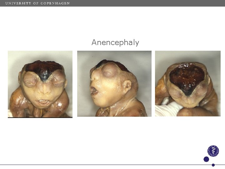 Anencephaly 